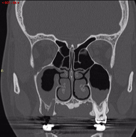 Tooth Root in the Maxillary Sinus