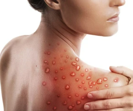 Monkeypox, A Global Health Emergency
