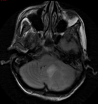 Granulocytic Sarcoma in HIV/AIDS