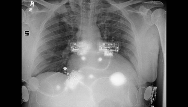 Wearable Cardiac Defibrillator