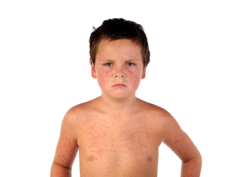 U.S. Measles Outbreak Hits 107 Cases in 21 States, D.C.