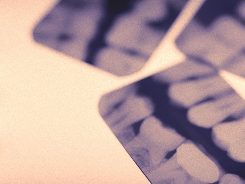 Periodontal Disease History Linked to Increased Cancer Risk