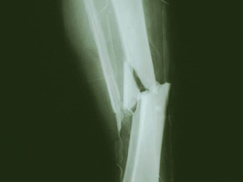 Empagliflozin Doesn't Up Risk of Bone Fractures