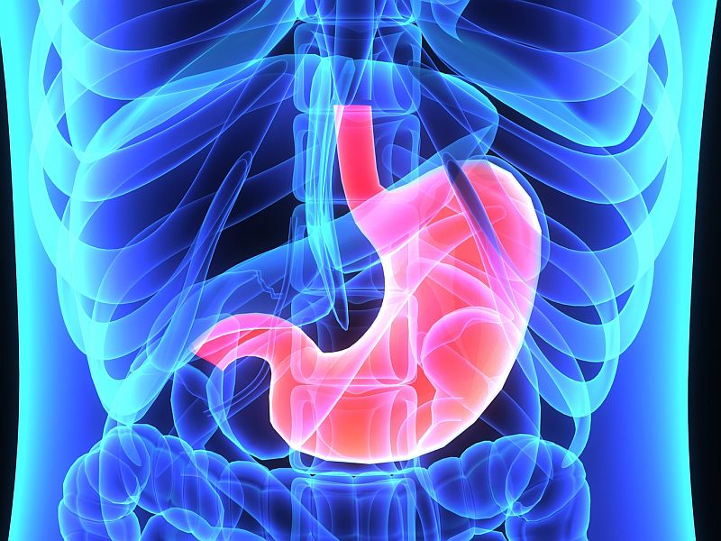 Mortality Down Only for Gastric Bypass Patients With Diabetes