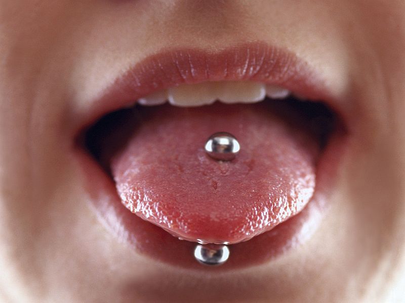 Periodontal Inflammation a Risk With Tongue Piercing