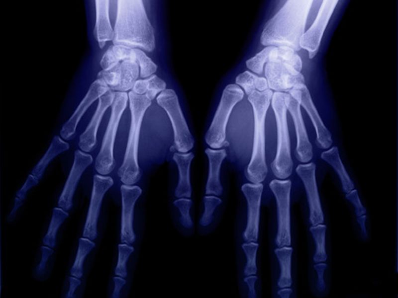 Steroid Injection Betters Hand Function With Carpal Tunnel