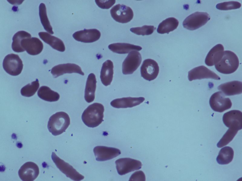 <small>L</small>-Glutamine Reduces Number of Pain Crises in Sickle Cell Disease