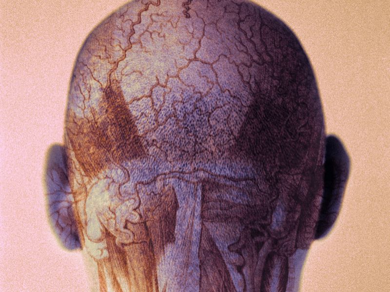 Approach Offers Regional Control of HPV-Related Head, Neck CA