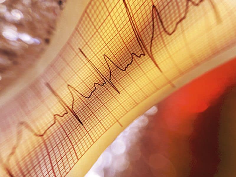 New Risk Score Promising for Predicting MI, Death