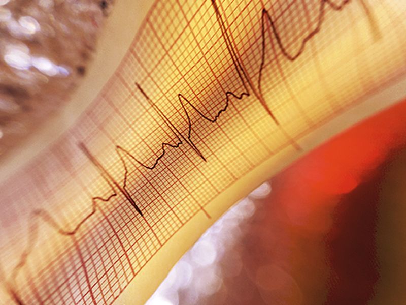 AICDs Effective for Symptoms, Lethal Arrhythmia in Brugada