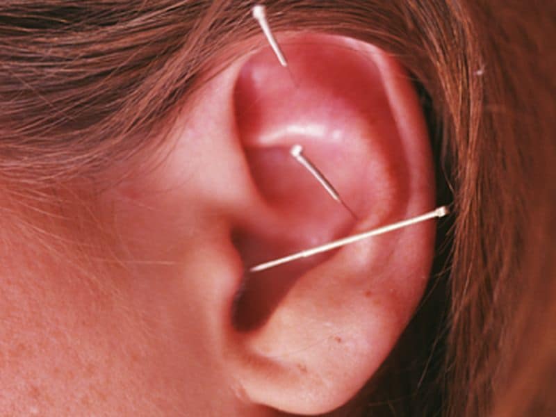 Acupuncture May Cut Arthralgia From Aromatase Inhibitors