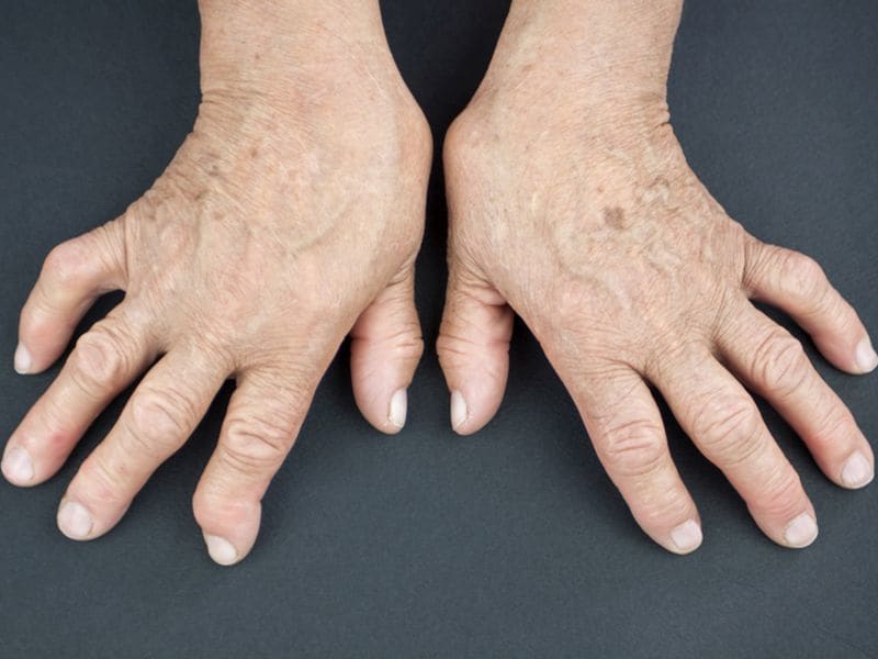 Combo Therapy Not Needed If Low RA Disease Activity Achieved