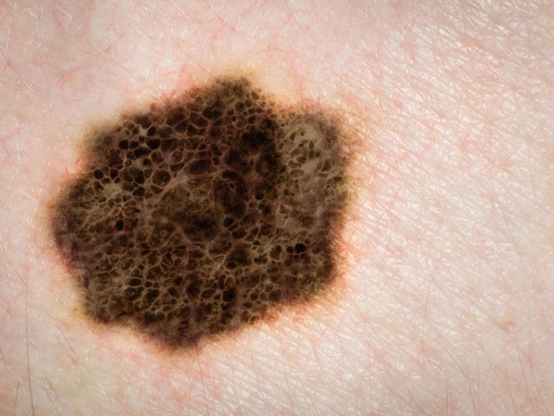 Computed Tomography Useful for Staging Head, Neck Melanoma