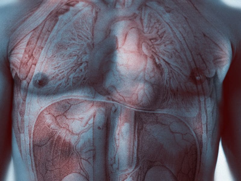 Excess Cardiac Risk Varies With Age of Onset of T1DM