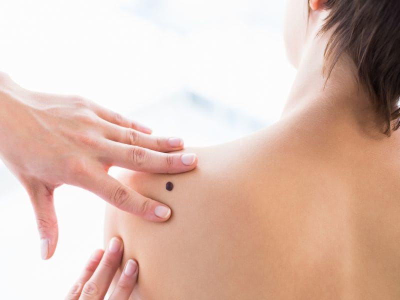 Review: Treatments for Primary Basal Cell Carcinoma Compared