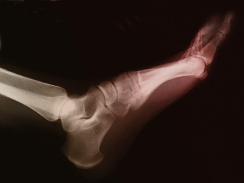 Quarterly Canakinumab Reduces Risk for Gout Attacks