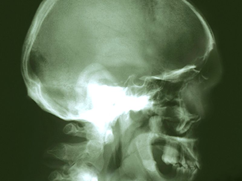 Patient Profile Impacts QOL With Radiation Tx in Head, Neck Cancer