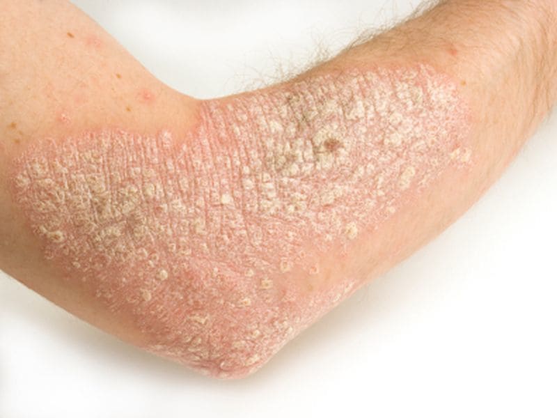 Inverse Link for Mediterranean Diet Score, Severe Psoriasis