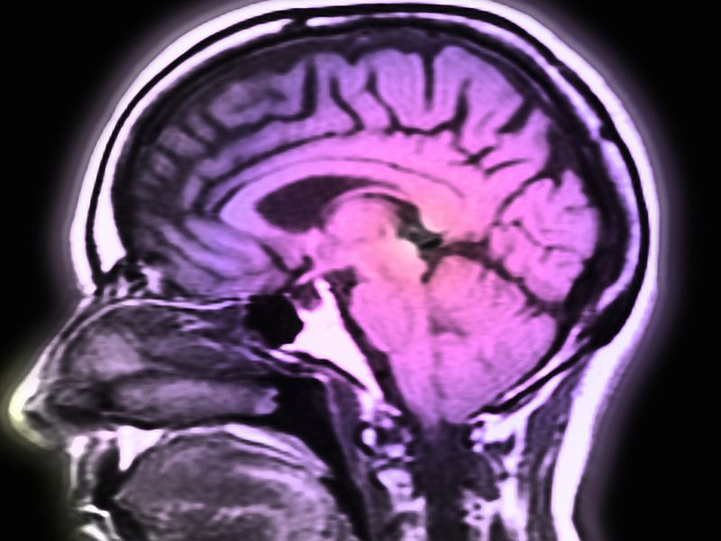 Parkinson's Medications Tied to Impulse Control Disorders