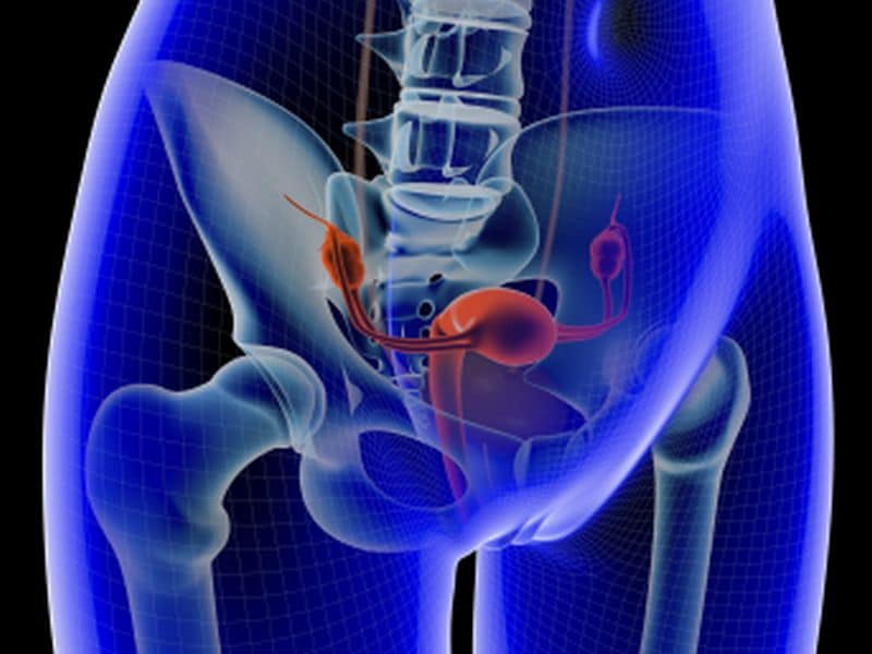 Newer Hormonal Contraception May Cut Ovarian Cancer Risk