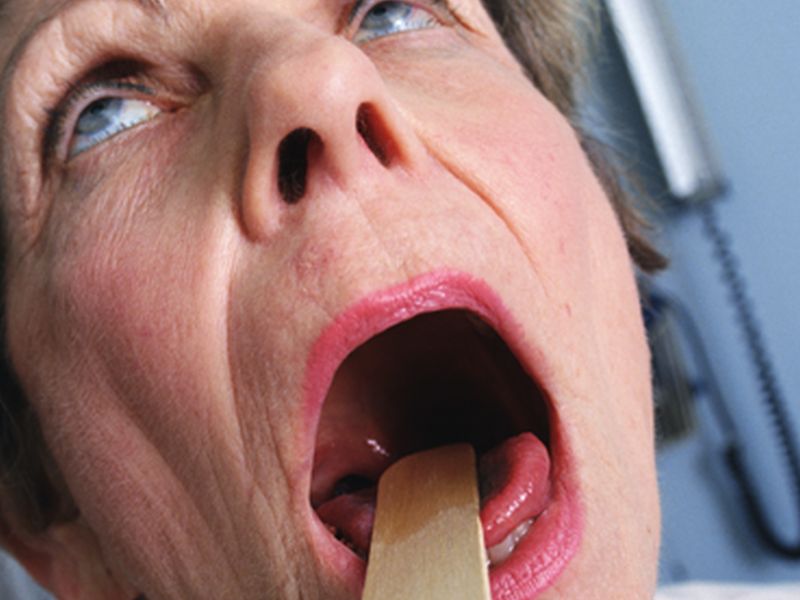 In-Office Angiolytic Laser Effective for Vocal Polyps