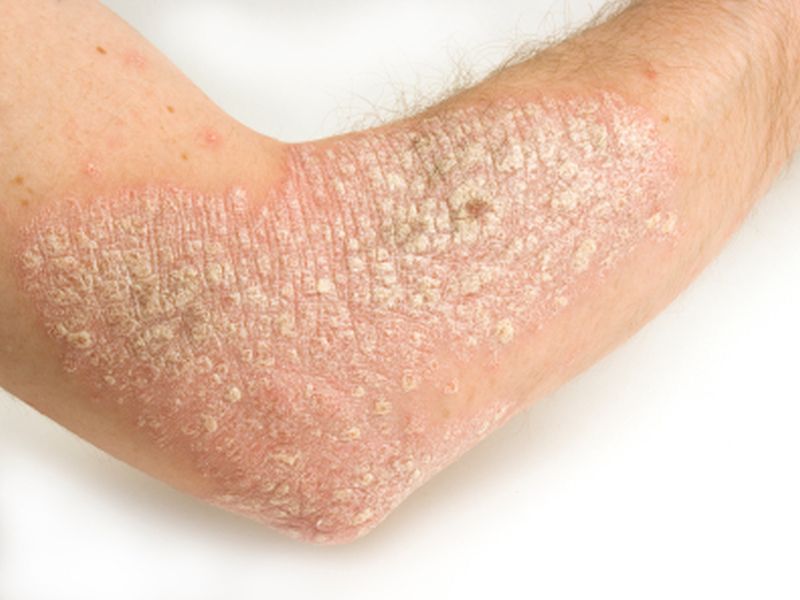 Herpes Zoster Risk Not Up in Systemically Treated Psoriasis