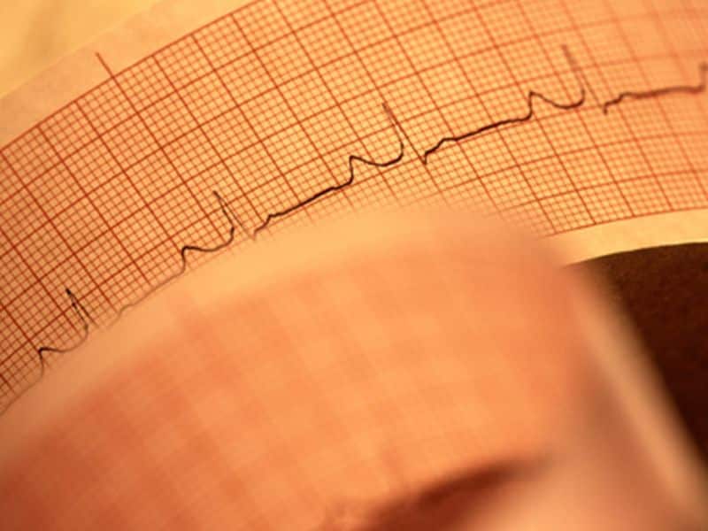 Ranolazine Doesn't Cut VT, VF, Death in High-Risk ICD Patients
