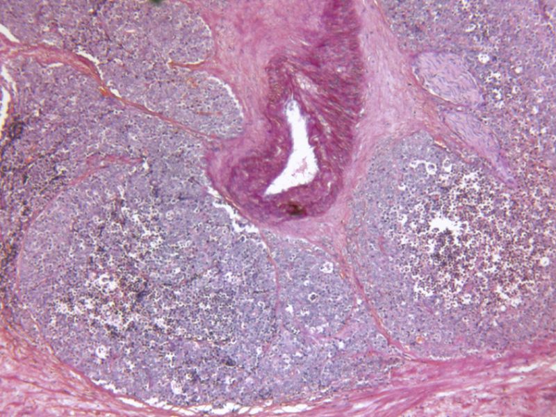 Hazard Score Can Estimate Age of Prostate Cancer Diagnosis