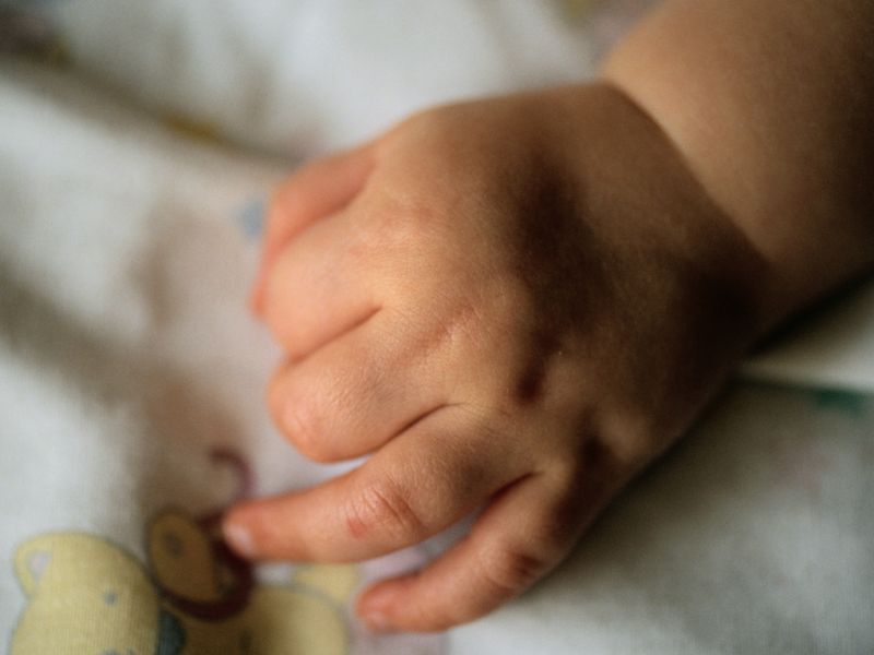 Nusinersen Beneficial in Later-Onset Spinal Muscular Atrophy