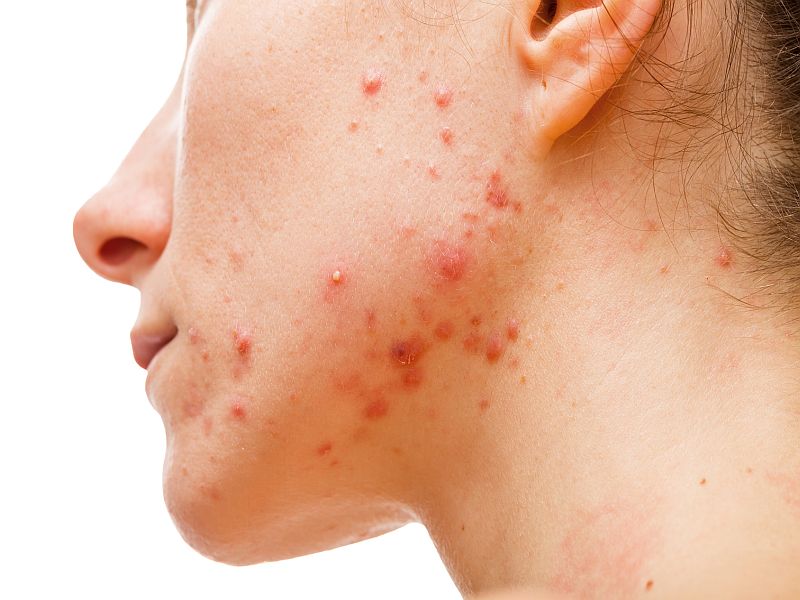 Acne Linked to Increased Risk of Major Depressive Disorder