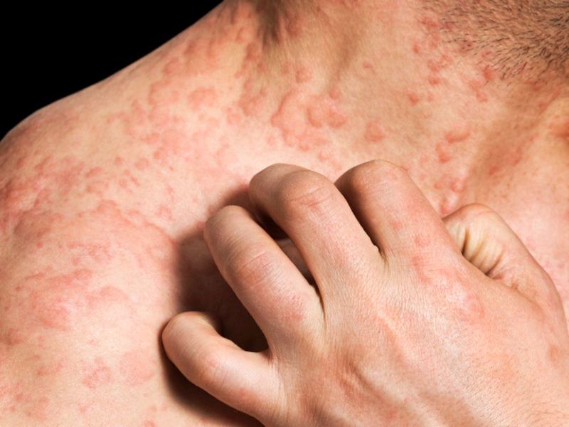 New Framework Guides Tx Decisions for Atopic Dermatitis