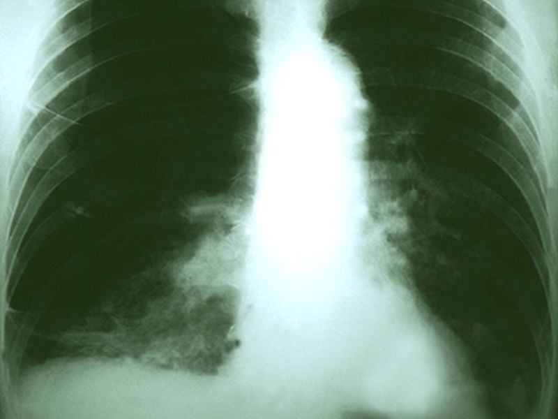Missed Opportunities to Screen for Lung CA With USPSTF Criteria