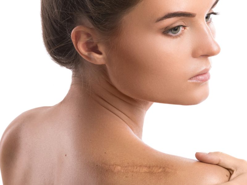 Patients, Doctors Often Disagree About Surgical Scar Evaluation