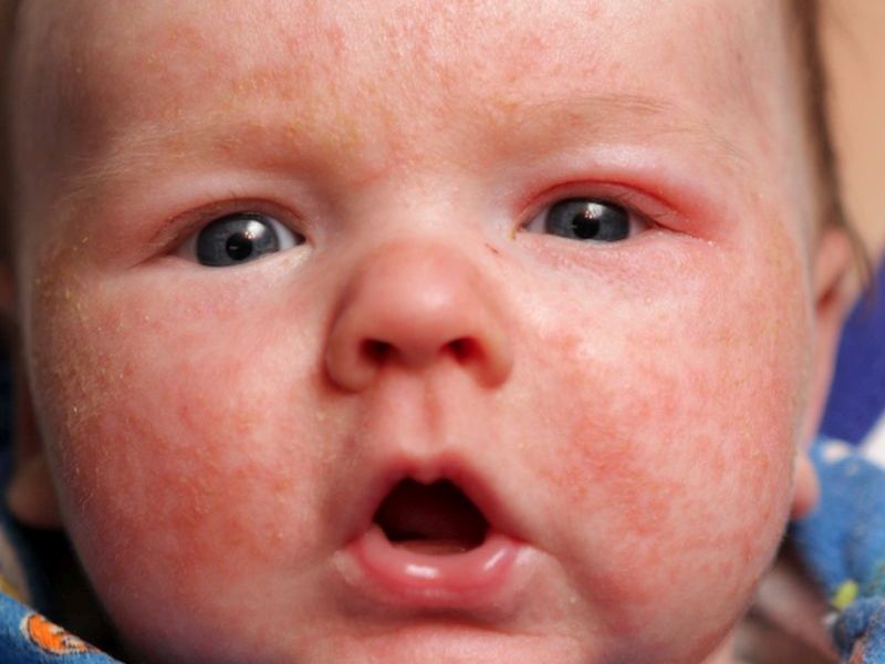 Probiotics in Infancy Do Not Reduce Incidence of Eczema