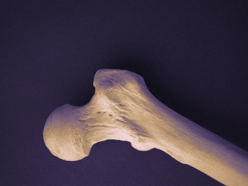 Revision Rates for Arthritis-Related Hip Replacement Down