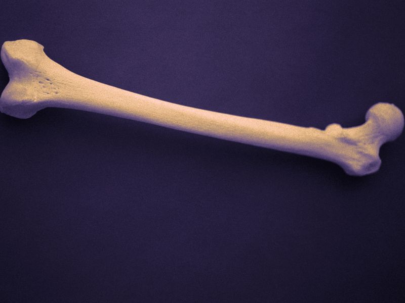 Osteoporosis Meds Up BMD in Nonmetastatic Prostate Cancer