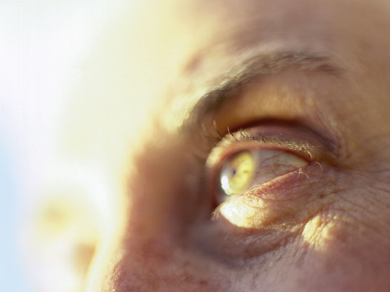 18-Item Measure Reliable for Symptom Burden in Glaucoma
