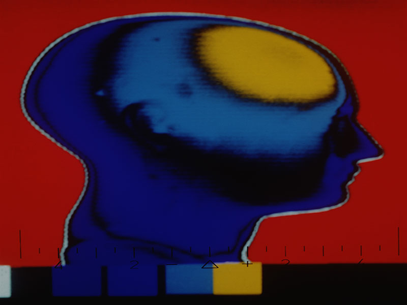 Midlife Vascular Risk Factors Tied to Increased Risk of Dementia