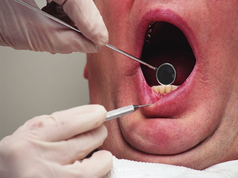 Periodontitis in Older Adults Tied to Higher Total Cancer Risk