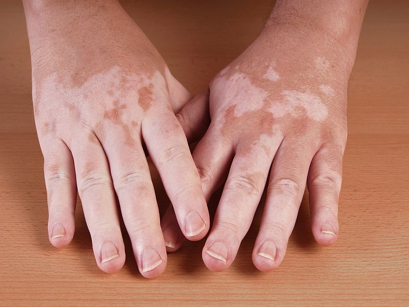 CO<sub>2</sub> Laser + Platelet-Rich Plasma Promising Treatment for Vitiligo
