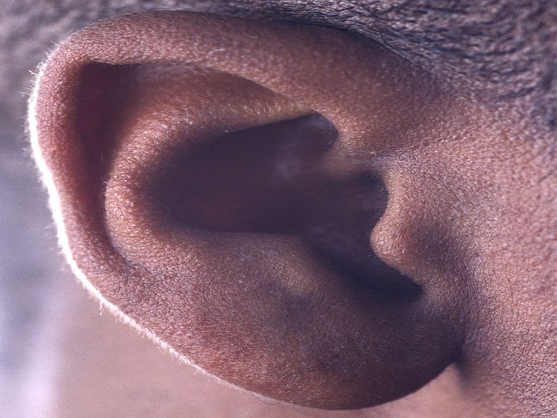 Increased Dementia Risk With Hearing Loss in Older Adults