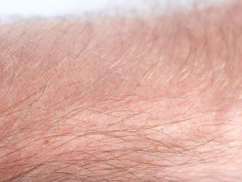 Hirsutism Strongly Predicts Metabolic Dysfunction in PCOS