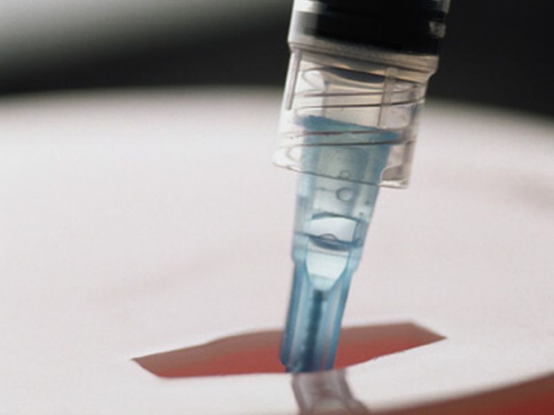 Exenatide Doesn't Up Cardiovascular Risk in T2DM