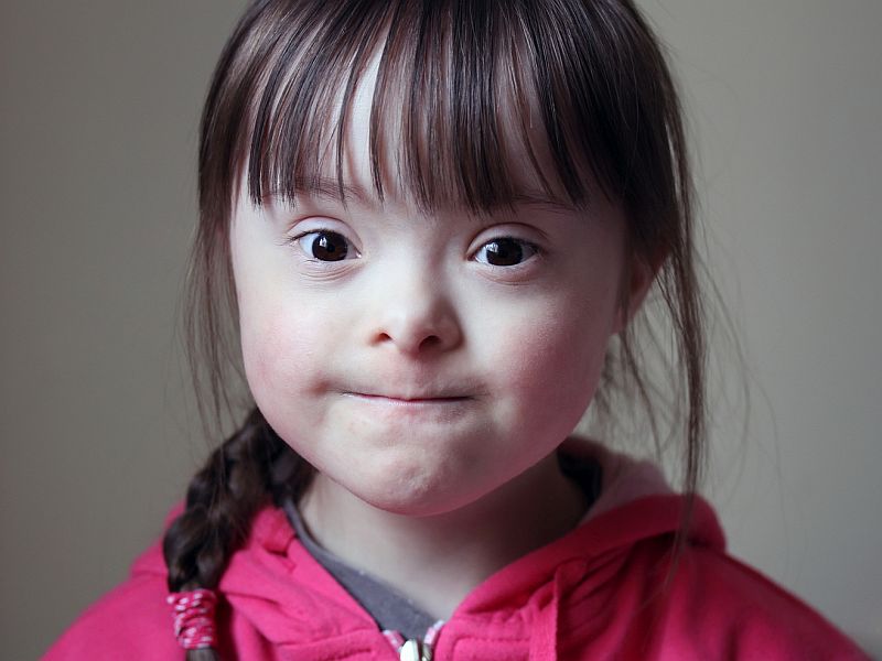 Corneal Abnormalities Seen With Down Syndrome