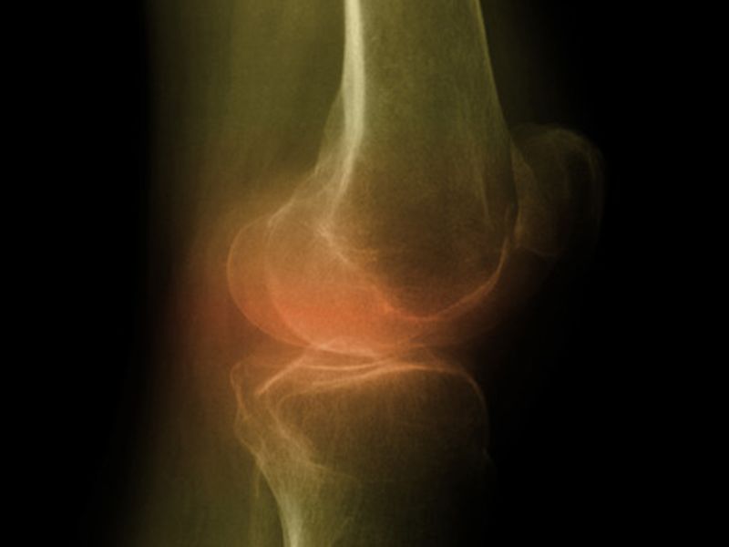 Hip Bone Mineral Density Tied to Knee Cartilage Defects