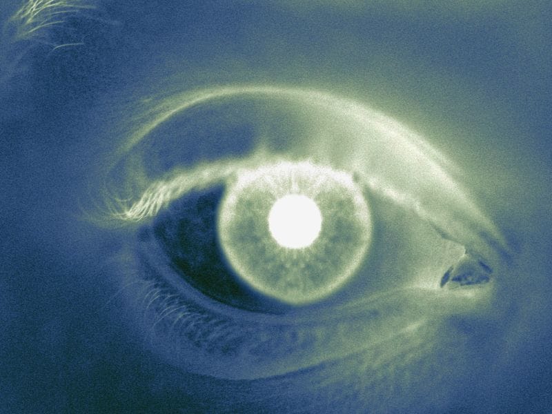 Retinal Abnormalities May Indicate Preclinical Alzheimer's