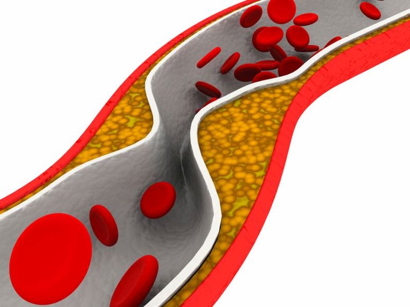 Lipoproteins, Lipids Have Similar Ties to MI, Ischemic Stroke