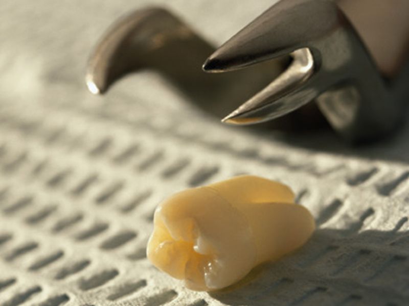 Mercury Released From Amalgam Fillings After High-Power MRI