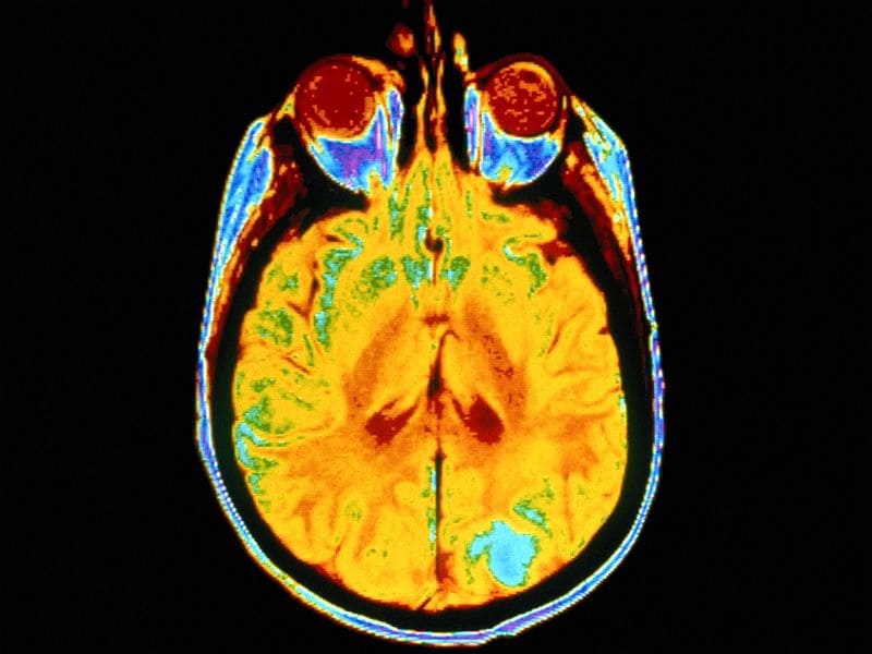 Novel Immunotherapy May Up Survival in Melanoma Brain Mets