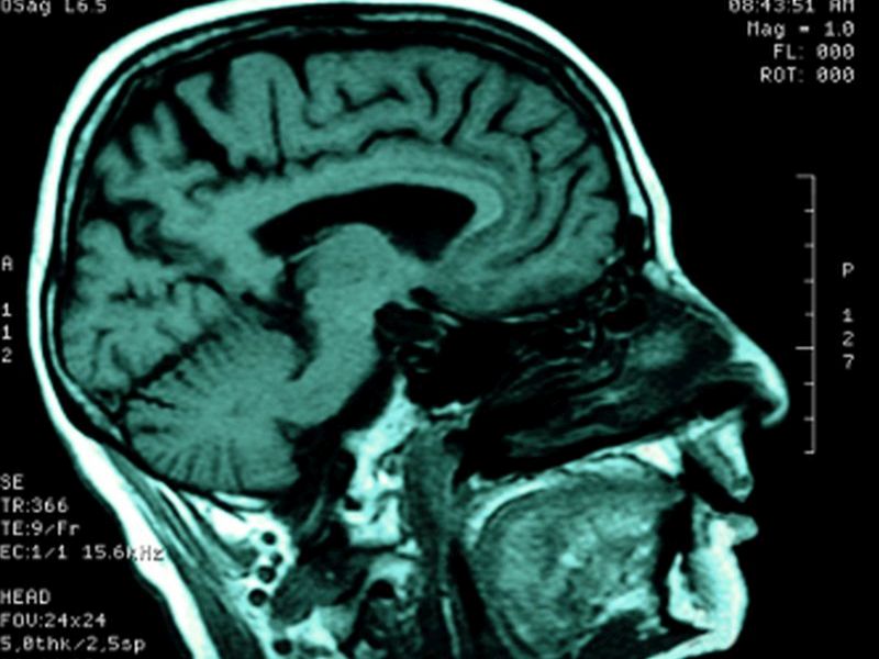 Impaired White Matter Integrity for Depression in Parkinson's